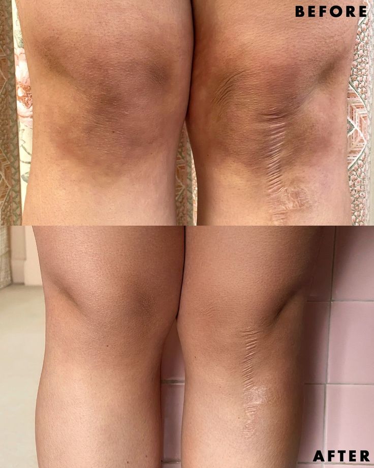 ALMOHADILLAS BLANQUEADORAS DE CURCUMA 2